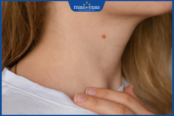 nốt ruồi cổ dưới cằm