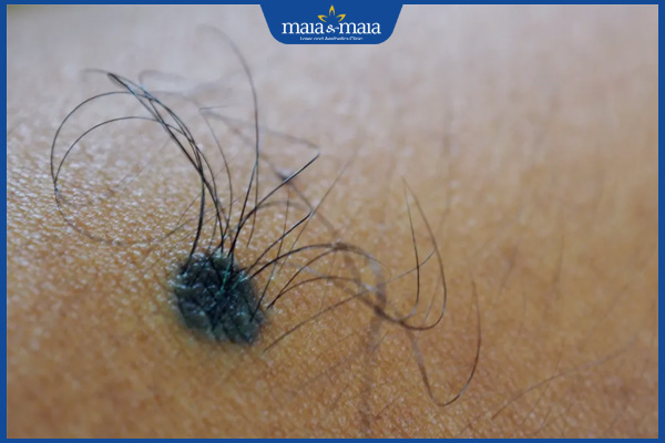 nốt ruồi có lông