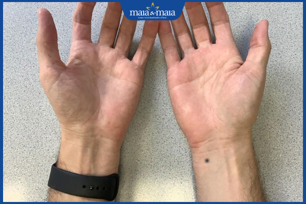 nốt ruồi cổ tay trái