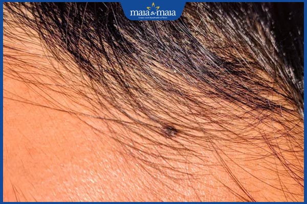 nốt ruồi cung thiên di