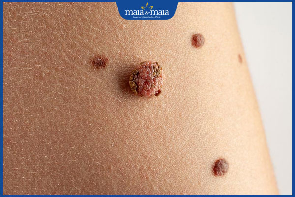 nốt ruồi dấu hiệu ác tính