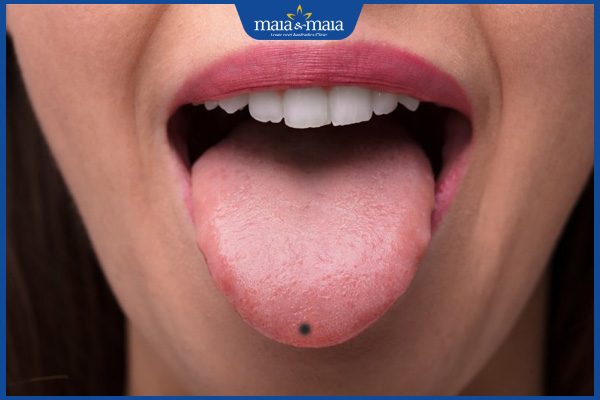 nốt ruồi đầu lưỡi