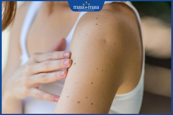 nốt ruồi đen bắp tay