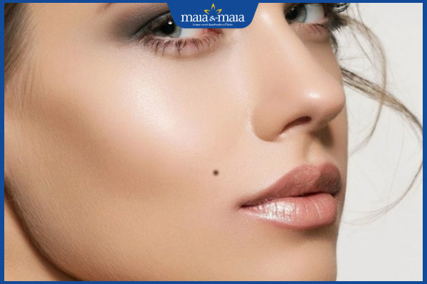 nốt ruồi đẹp ở má