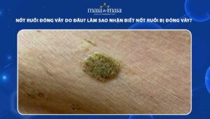 nốt ruồi đóng vảy