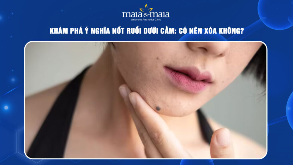 Nốt ruồi dưới cằm