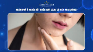 Nốt ruồi dưới cằm