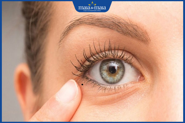 nốt ruồi dưới hốc mắt