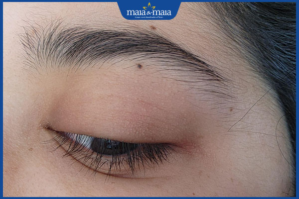 nốt ruồi dưới lông mày