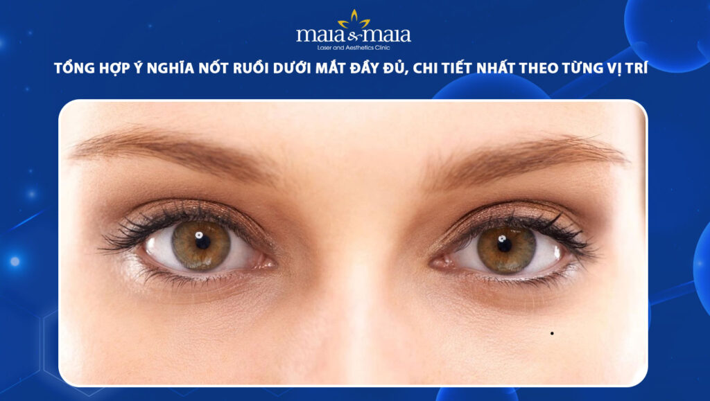 nốt ruồi dưới mắt