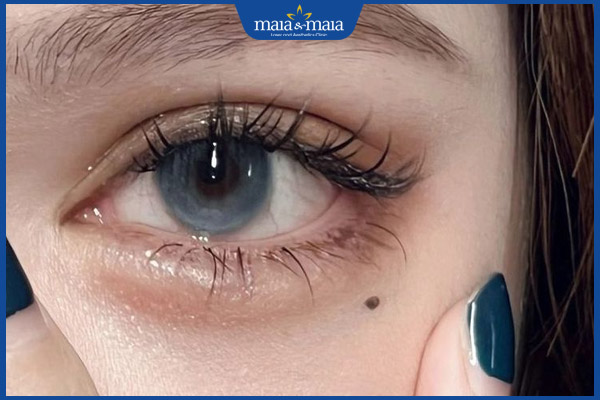 nốt ruồi dưới mắt trái