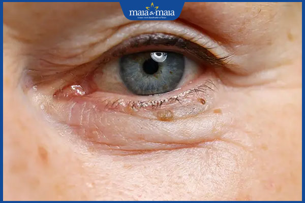 nốt ruồi dưới mí mắt