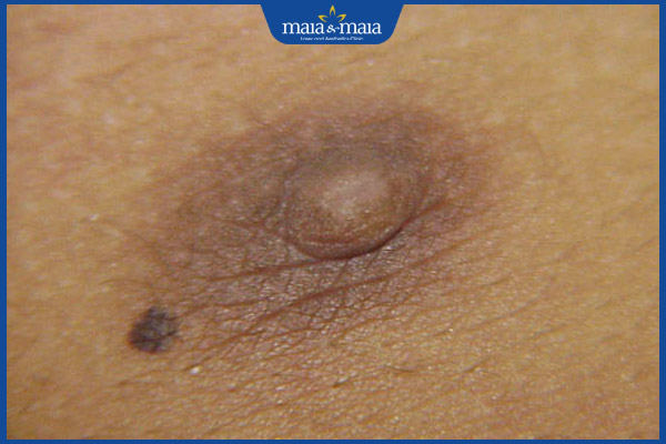 nốt ruồi dưới nhũ hoa