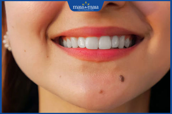 nốt ruồi duyên quanh miệng