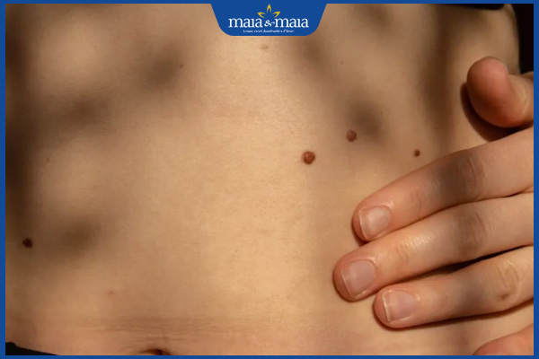 nốt ruồi eo bụng 