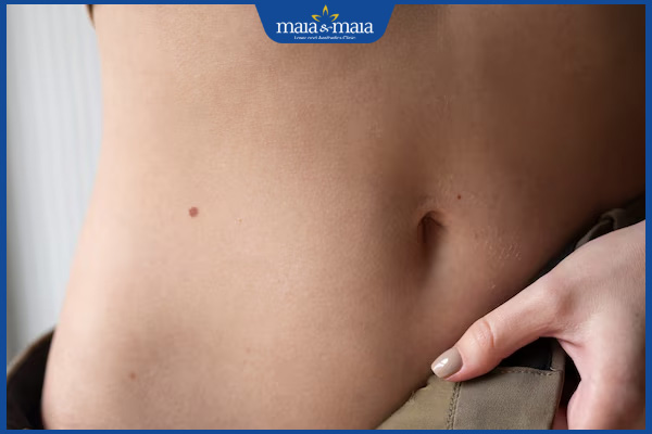 nốt ruồi eo trái