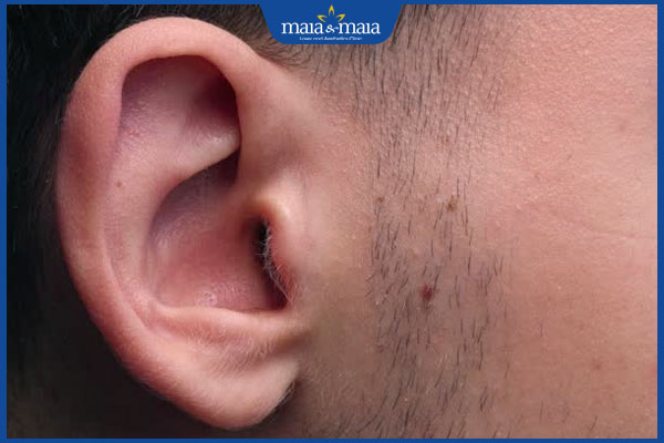 Luận giải ý nghĩa 6 vị trí nốt ruồi ở tai cho nam và nữ giới 5 nốt ruồi gần tai