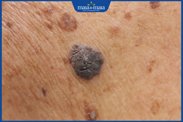 nốt ruồi hậu môn nam