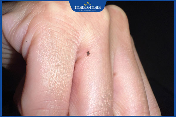 Nốt ruồi ở ngón tay có ý nghĩa gì? Có nên tẩy không? 4 nốt ruồi kẽ tay