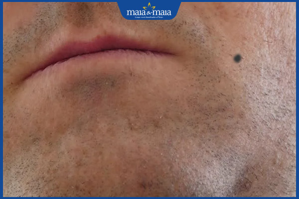 nốt ruồi khóe miệng nam