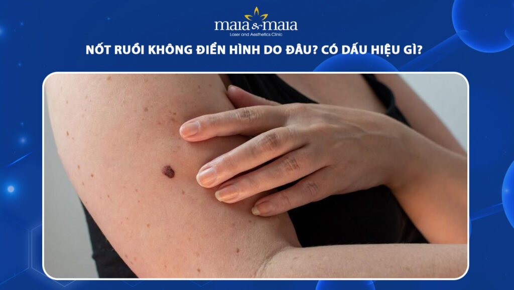 Nốt ruồi không điển hình nguy hiểm không? Dấu hiệu nhận biết 1 nốt ruồi không điển hình