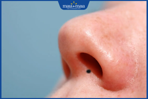 nốt ruồi lỗ mũi