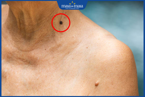 nốt ruồi lỗ tiền chôn