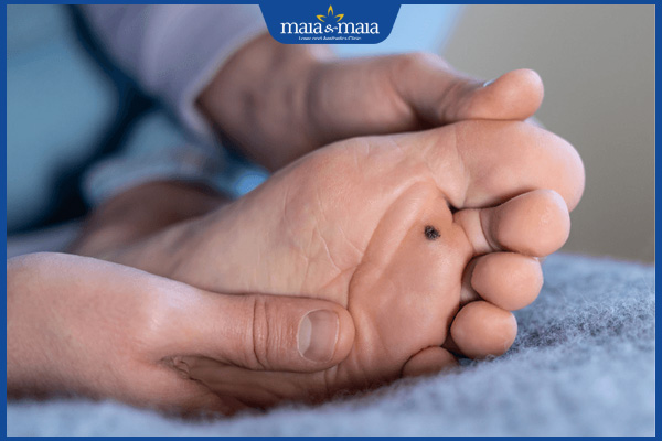 nốt ruồi lòng bàn chân trái