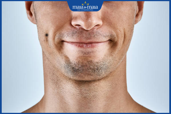 nốt ruồi má lúm