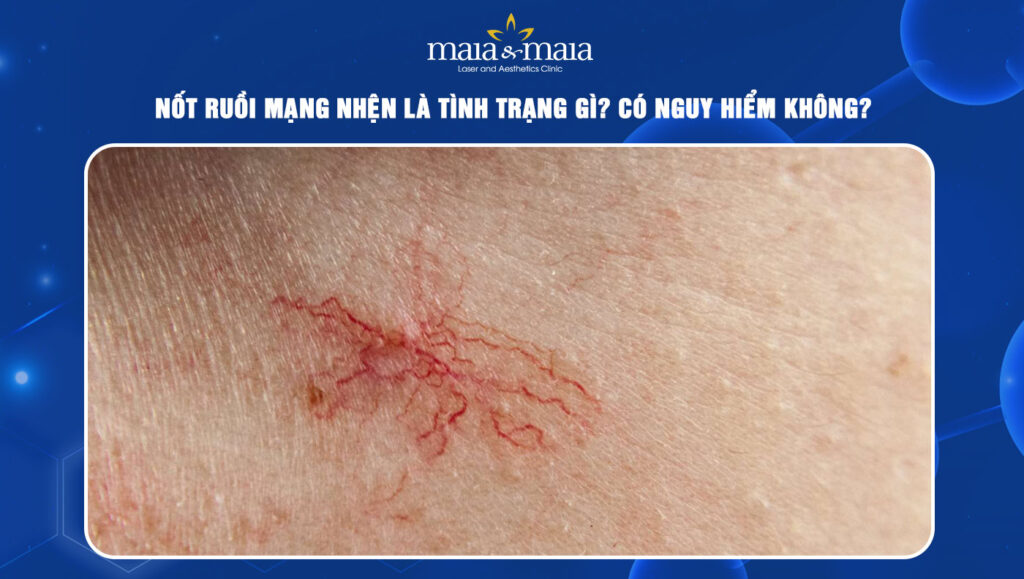 Nốt ruồi mạng nhện là tình trạng gì? Có nguy hiểm không? 1 Nốt ruồi mạng nhện