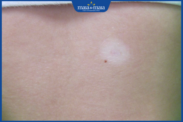 nốt ruồi màu trắng