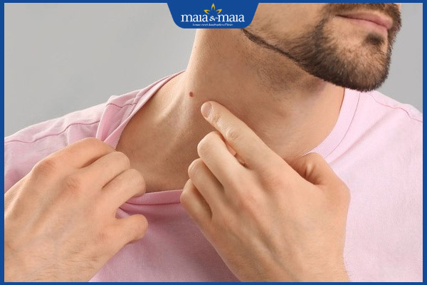 nốt ruồi may mắn ở nam