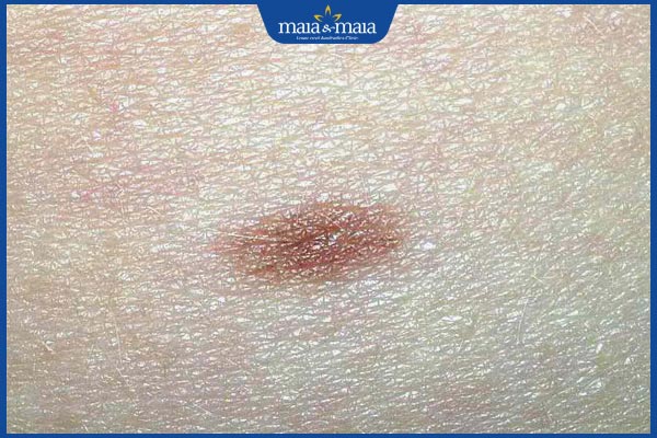 nốt ruồi mọc lại