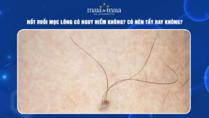 Nốt ruồi mọc lông