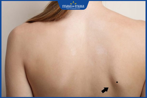 Ý nghĩa các vị trí nốt ruồi ở vai trong nhân tướng học 5 nốt ruồi mọc ở bả vai