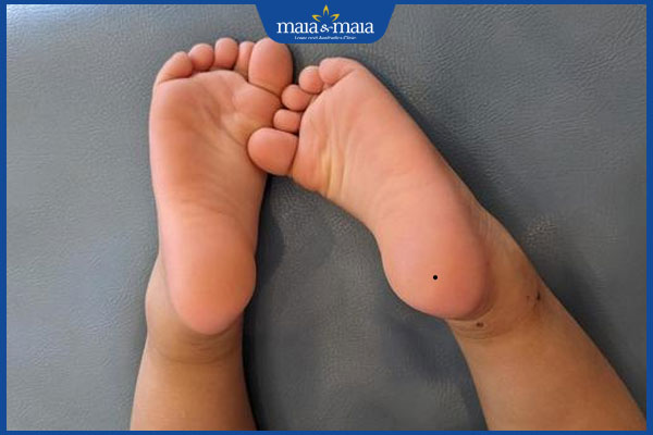 nốt ruồi mọc ở gót chân