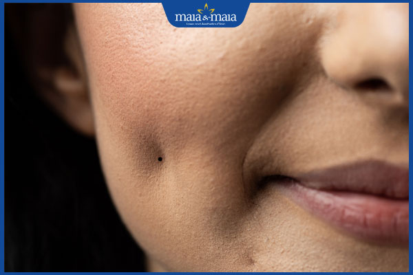 nốt ruồi mọc ở má lúm