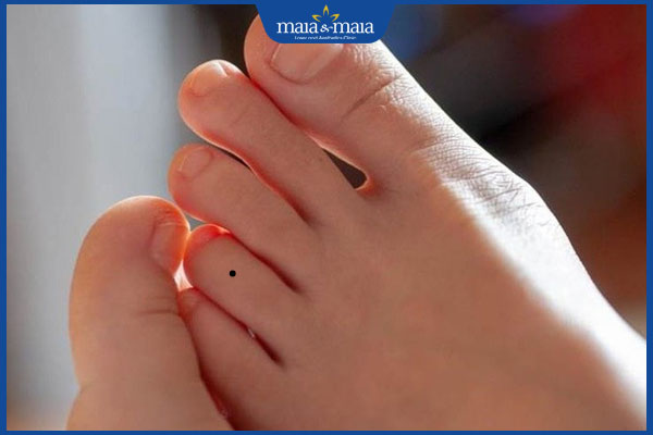 nốt ruồi mọc ở ngón chân áp út