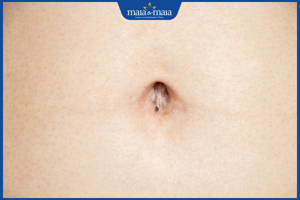 nốt ruồi mọc ở rốn