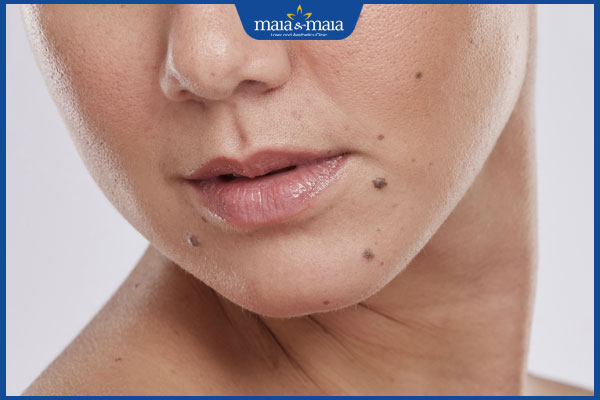 nốt ruồi mọc ở trên mặt