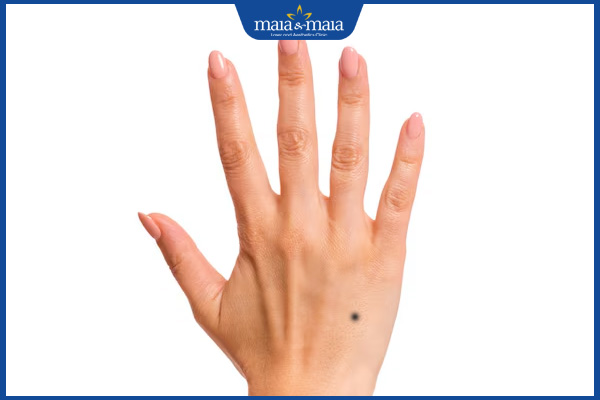 nốt ruồi mu bàn tay phải nữ