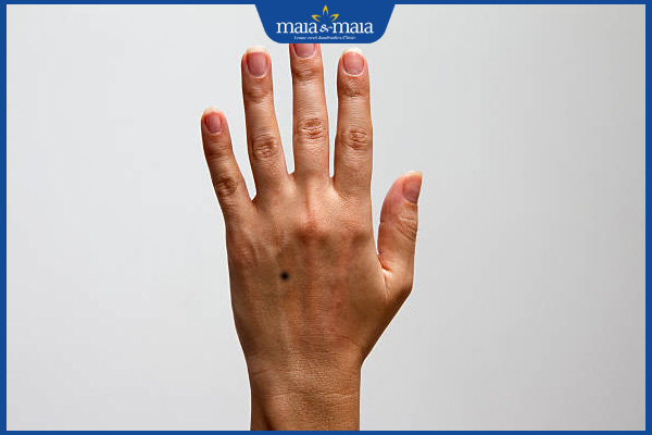 nốt ruồi mu bàn tay trái nam