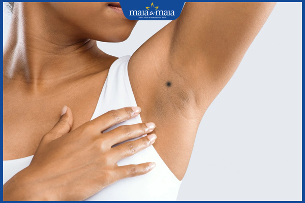 Nốt ruồi ở nách là tốt hay xấu? Khi nào nên loại bỏ? 2 nốt ruồi nách trái nữ