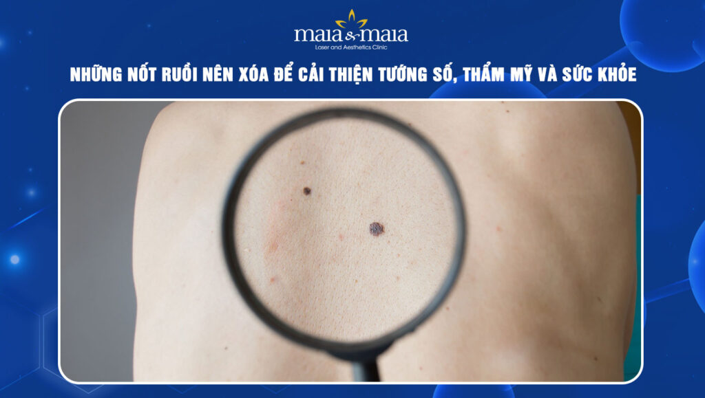 nốt ruồi nên xóa