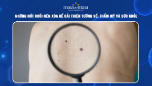 nốt ruồi nên xóa