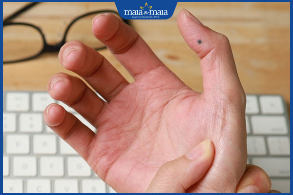 Nốt ruồi ở ngón tay có ý nghĩa gì? Có nên tẩy không? 2 nốt ruồi ngón cái