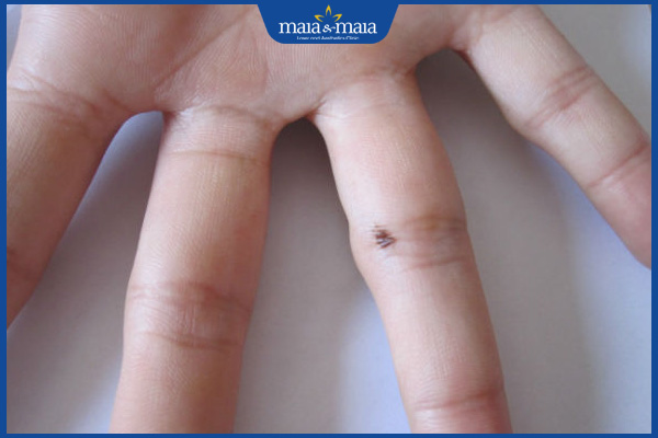 nốt ruồi ngón tay