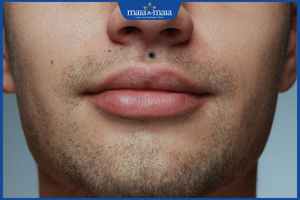 Điểm mặt 10 nốt ruồi lận đận tình duyên và cách hóa giải 4 nốt ruồi nhân trung nam