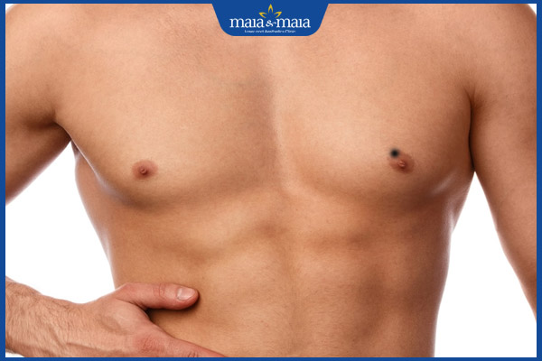 nốt ruồi nhũ hoa nam