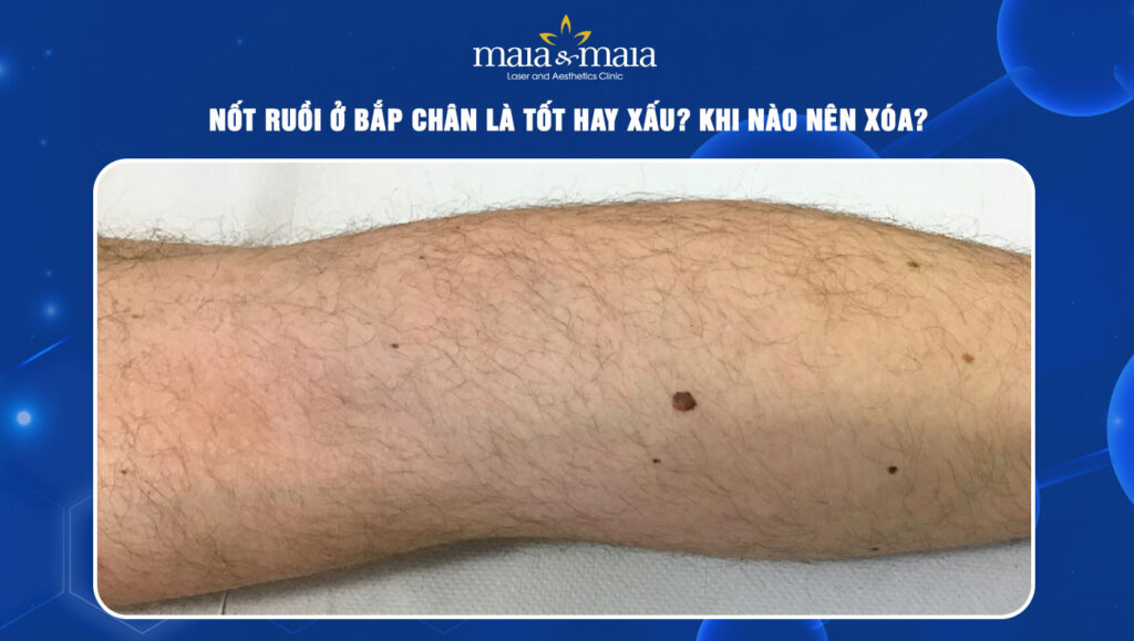 nốt ruồi ở bắp chân